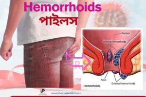 Hemorrhoids Piles