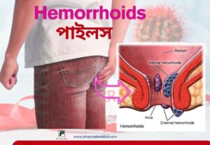Hemorrhoids Piles