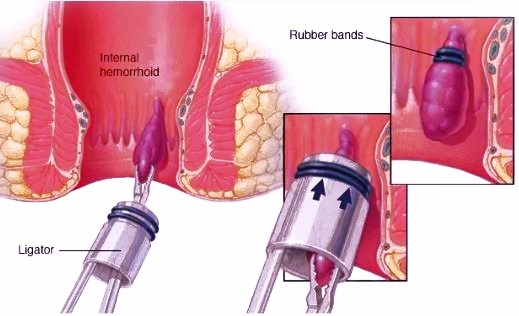 Piles (Hemorrhoids) band ligation